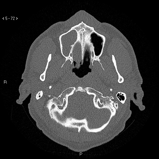 Antrochoanal Polyp (Radiopaedia 70510-80631 Axial bone window 20).jpg
