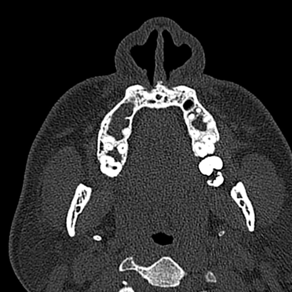 Antrochoanal polyp (Radiopaedia 30002-30554 Axial bone window 9).jpg
