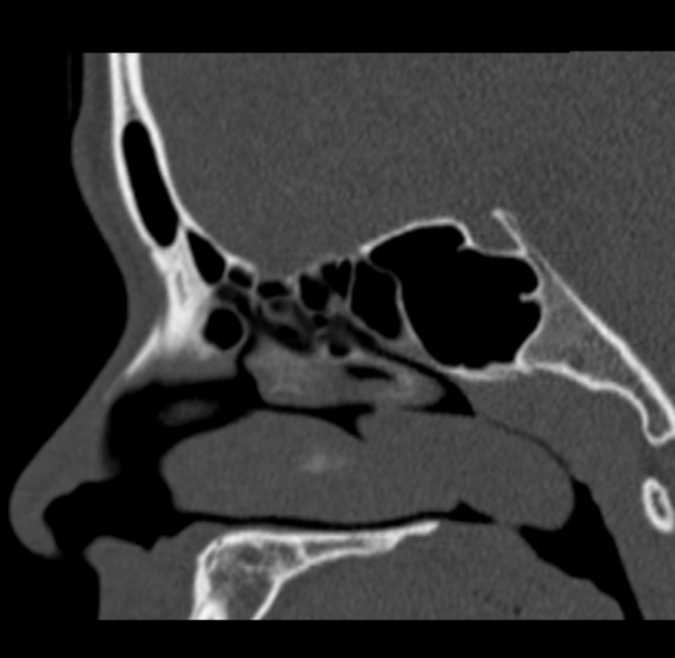 Antrochoanal polyp (Radiopaedia 33984-35202 Sagittal bone window 36).jpg