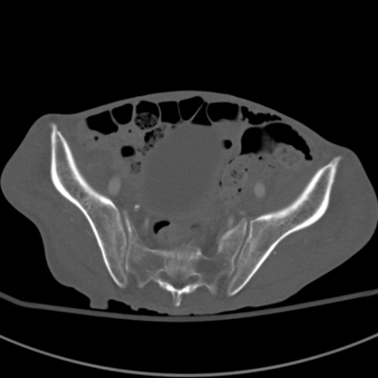 Aortic aneurysm with spinal destruction (Radiopaedia 42301-45410 Axial bone window 87).jpg