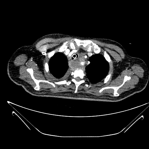 Aortic arch aneurysm (Radiopaedia 84109-99365 B 113).jpg