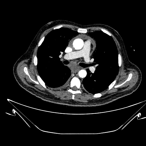 Aortic arch aneurysm (Radiopaedia 84109-99365 B 289).jpg