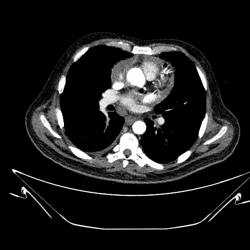 Aortic arch aneurysm (Radiopaedia 84109-99365 B 323).jpg
