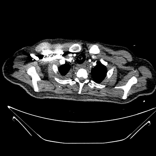 Aortic arch aneurysm (Radiopaedia 84109-99365 B 82).jpg