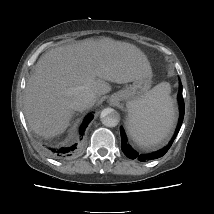 Aortic arch graft infection (FDG PET-CT) (Radiopaedia 71975-82437 A 56).jpg