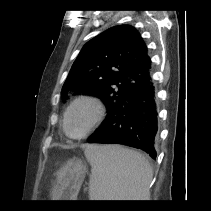 Aortic arch graft infection (FDG PET-CT) (Radiopaedia 71975-82437 C 53).jpg
