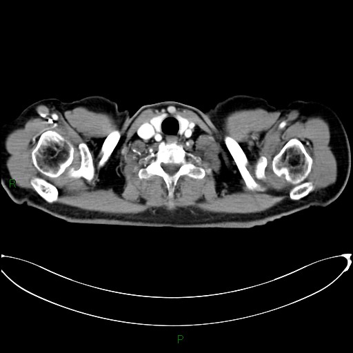 File:Aortic arch origin of left vertebral artery (Radiopaedia 46327-50737 Axial post contrast 2).jpg
