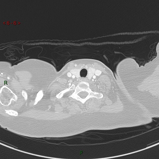 Aortic arch origin of left vertebral artery (Radiopaedia 51520-57286 Axial lung window 6).jpg