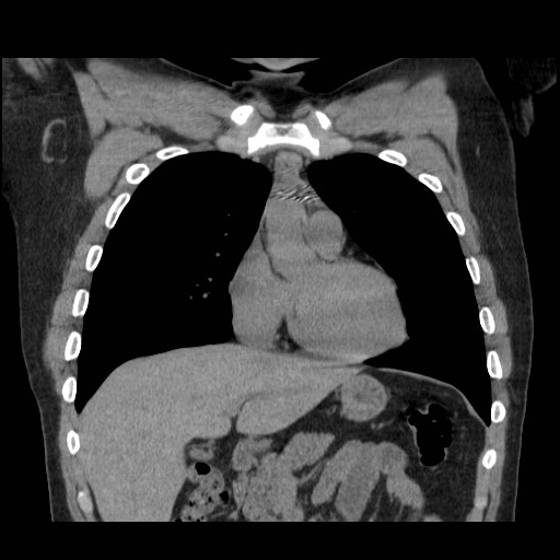 File:Aortic arch stent (Radiopaedia 30030-30595 Coronal non-contrast 1).jpg
