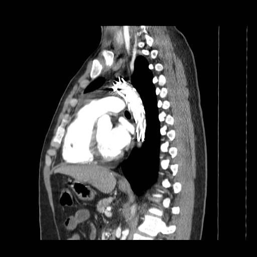 File:Aortic arch stent (Radiopaedia 30030-30595 E 14).jpg