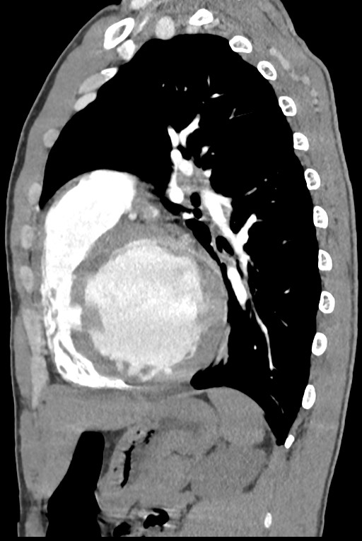 Aortic coarctation with aneurysm (Radiopaedia 74818-85828 B 107).jpg