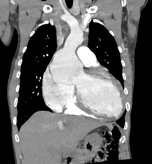 Aortic coarctation with aneurysm (Radiopaedia 74818-85828 C 42).jpg
