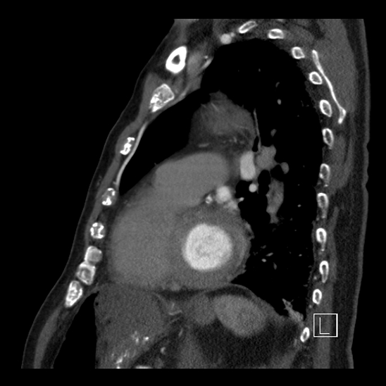 Aortic dissection (CTPA) (Radiopaedia 75506-86750 C 70).jpg