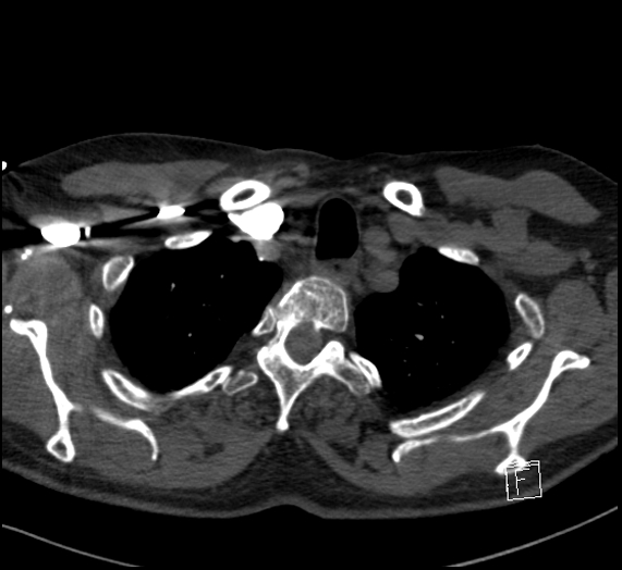 Aortic dissection (CTPA) (Radiopaedia 75506-86751 Axial C+ CTPA 20).jpg
