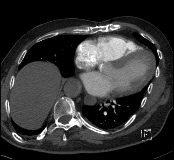File:Aortic dissection (CTPA) (Radiopaedia 75506-86751 Axial C+ CTPA 92).jpg