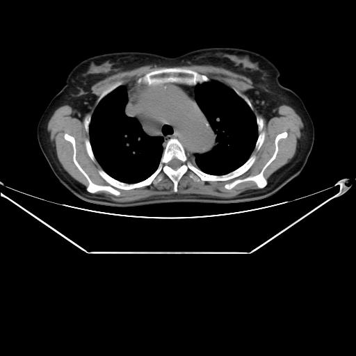 Aortic dissection (Radiopaedia 25350-25604 B 15).jpg