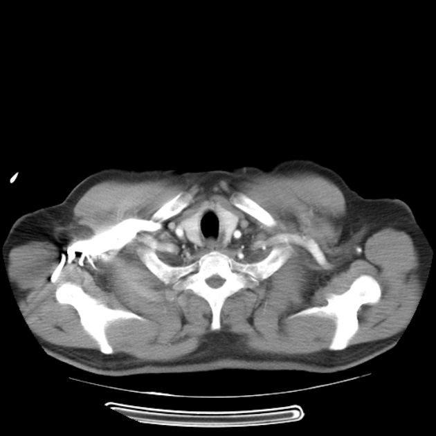 Aortic dissection (Radiopaedia 44411-48061 C 2).jpg