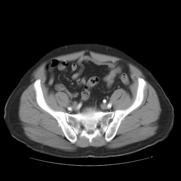 Aortic dissection (Radiopaedia 44411-48061 C 48).jpg