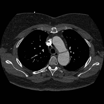 Aortic dissection (Radiopaedia 57969-64959 A 106).jpg