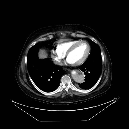 Aortic dissection (Radiopaedia 62562-71000 A 31).jpg
