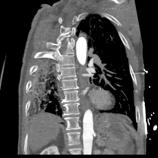 File:Aortic dissection - DeBakey type II (Radiopaedia 64302-73082 D 23).png