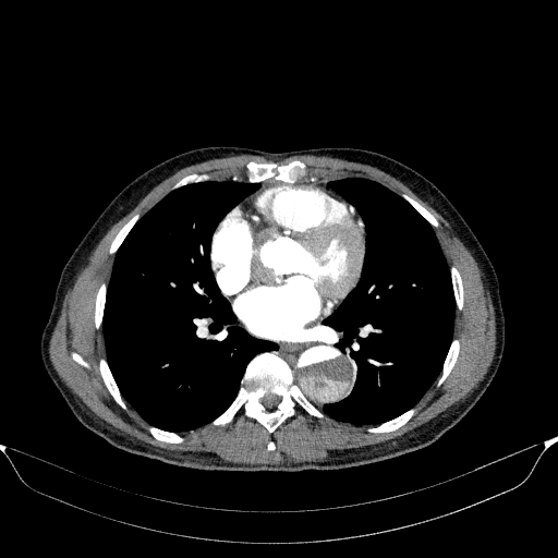 Aortic dissection - Stanford type A (Radiopaedia 83418-98500 A 37).jpg