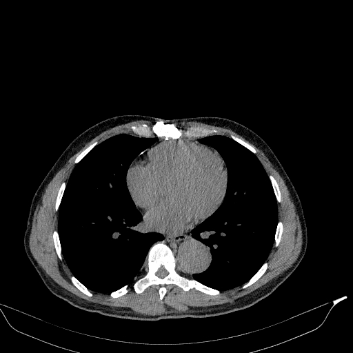 Aortic dissection - Stanford type A (Radiopaedia 83418-98500 Axial non-contrast 27).jpg