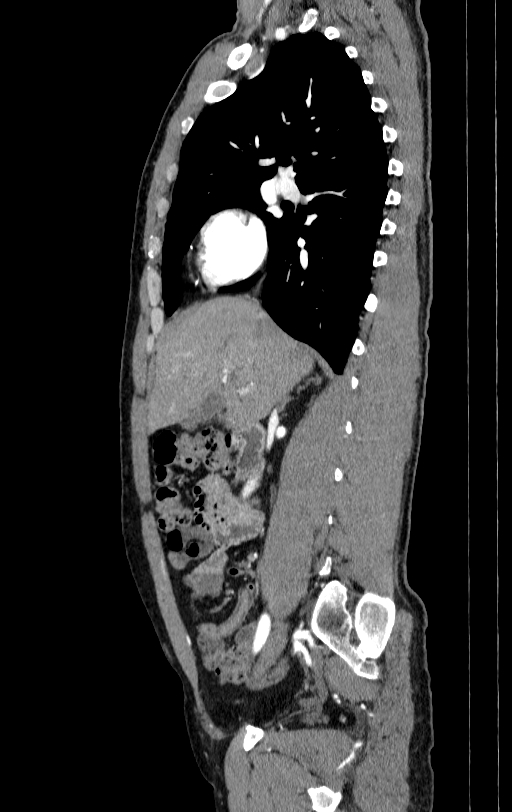 Aortic dissection - Stanford type A (Radiopaedia 83418-98500 B 8).jpg