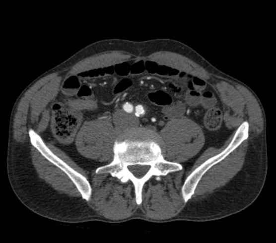 Aortic dissection - Stanford type B (Radiopaedia 73648-84437 A 199).jpg