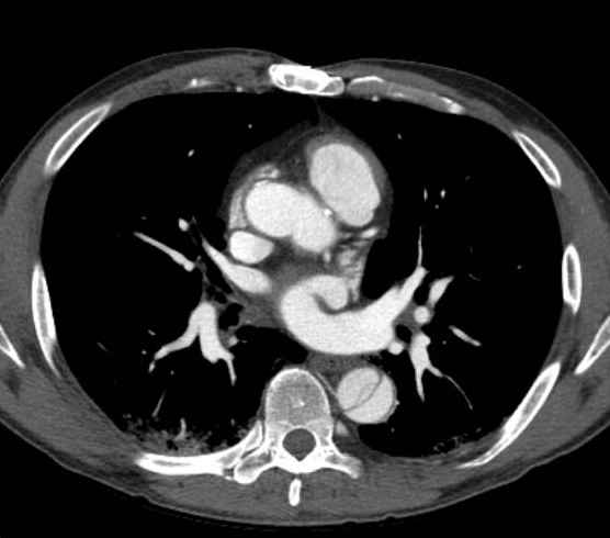 Aortic dissection - Stanford type B (Radiopaedia 73648-84437 A 56).jpg