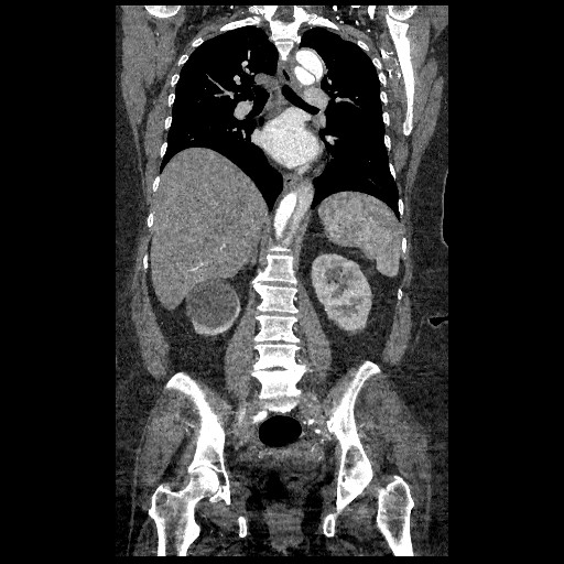 File:Aortic dissection - Stanford type B (Radiopaedia 88281-104910 B 49).jpg