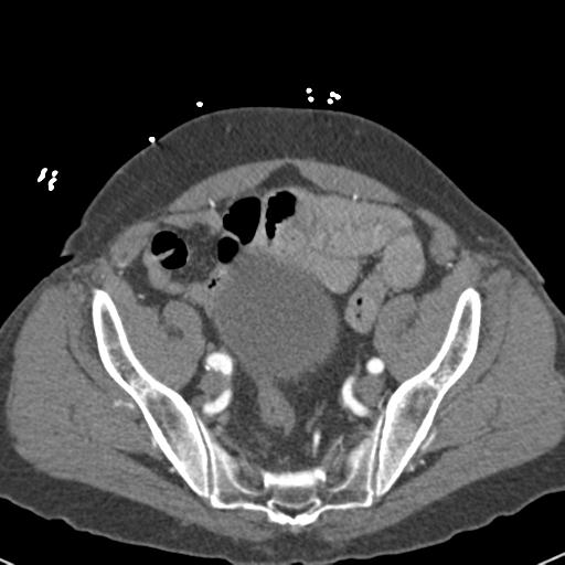 Aortic intramural hematoma (Radiopaedia 31139-31838 B 145).jpg