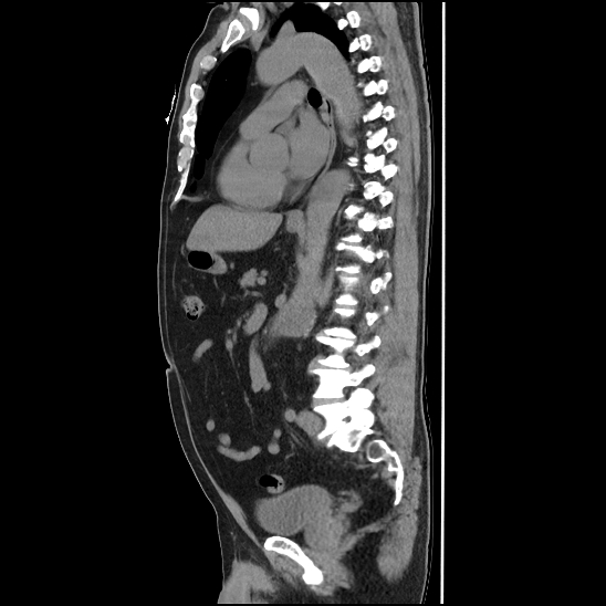 Aortic intramural hematoma (type B) (Radiopaedia 79323-92387 G 29).jpg