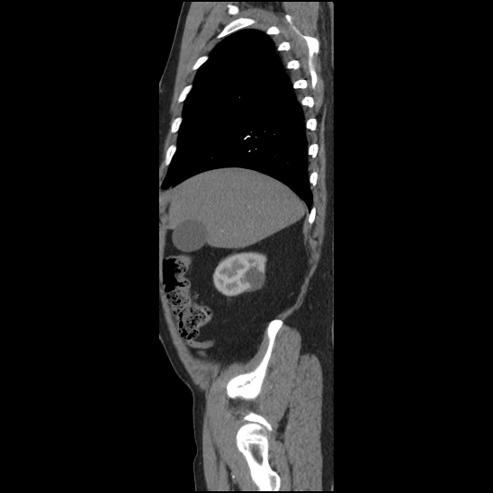 Aortic intramural hematoma (type B) (Radiopaedia 79323-92387 H 4).jpg