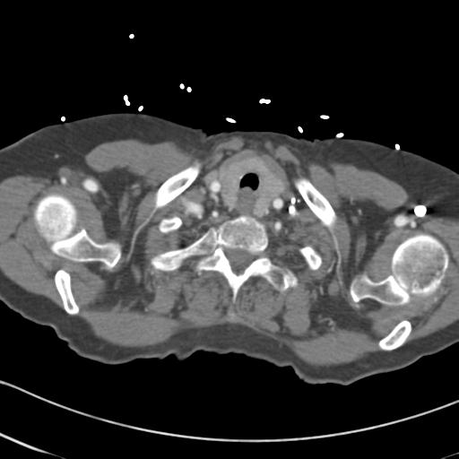 Aortic intramural hematoma from penetrating atherosclerotic ulcer (Radiopaedia 31137-31836 A 2).jpg