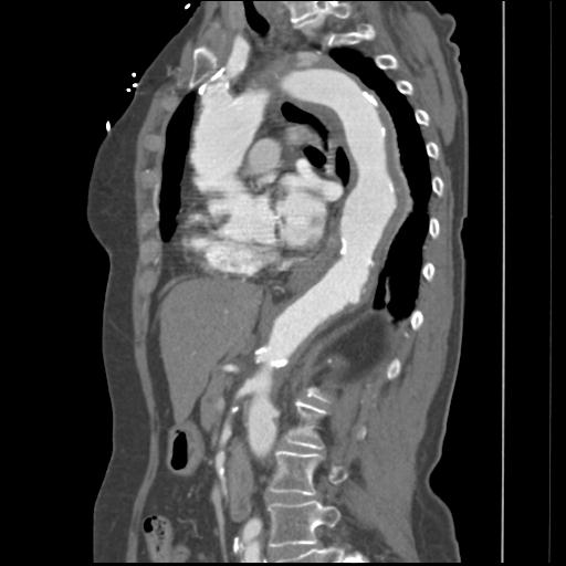 File:Aortic intramural hematoma from penetrating atherosclerotic ulcer (Radiopaedia 31137-31836 B 17).jpg