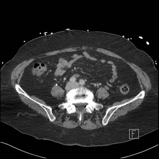 File:Aortic intramural hematoma with dissection and intramural blood pool (Radiopaedia 77373-89491 E 62).jpg