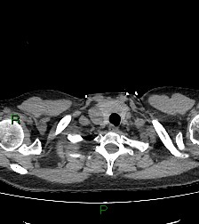 Aortic valve endocarditis (Radiopaedia 87209-103485 Axial non-contrast 11).jpg