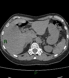 Aortic valve endocarditis (Radiopaedia 87209-103485 Axial non-contrast 95).jpg