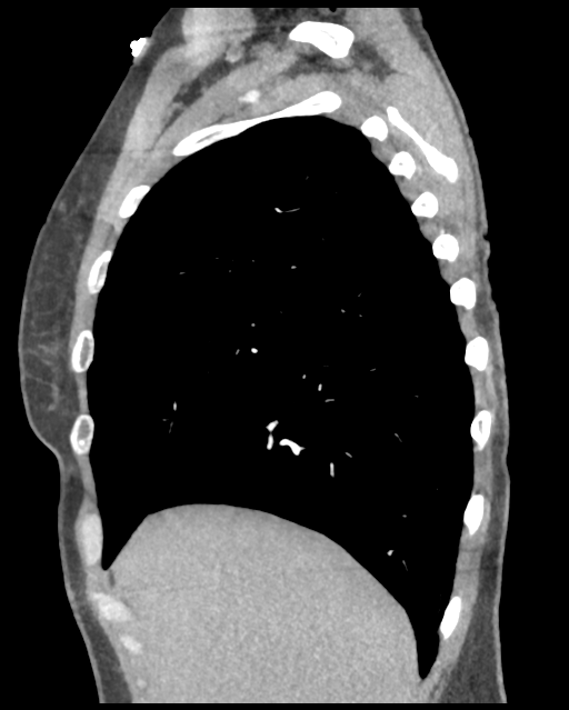 Aortic valve non-coronary cusp thrombus (Radiopaedia 55661-62189 D 42).png