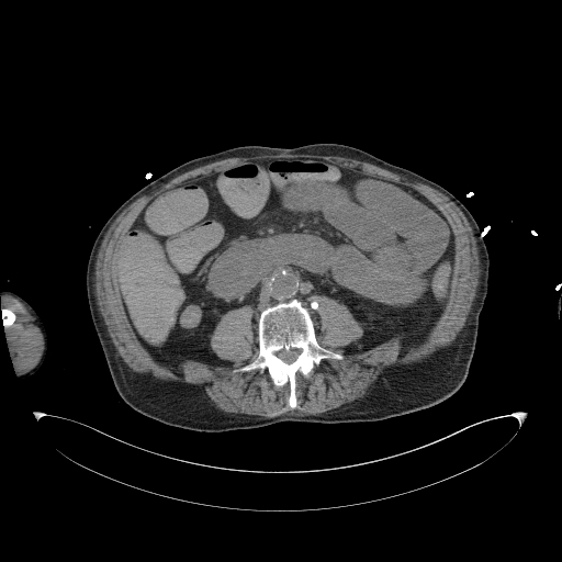 Aortoduodenal fistula (Radiopaedia 75286-86415 Axial non-contrast 38).jpg