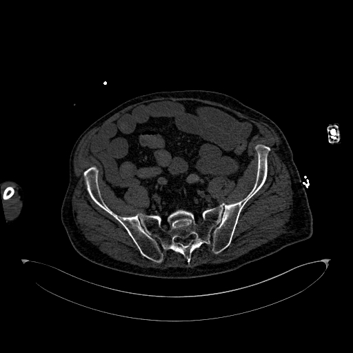 Aortoduodenal fistula (Radiopaedia 75286-86415 B 123).jpg