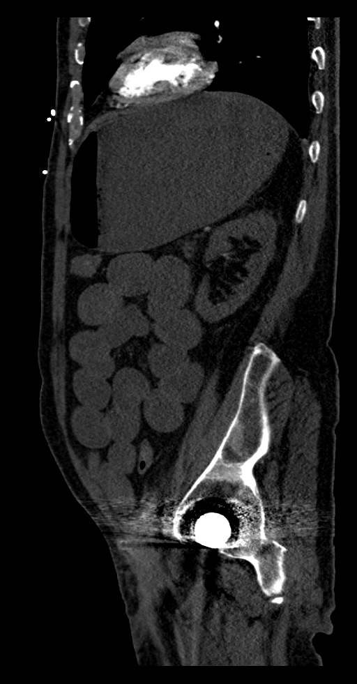 Aortoduodenal fistula (Radiopaedia 75286-86415 F 3).jpg