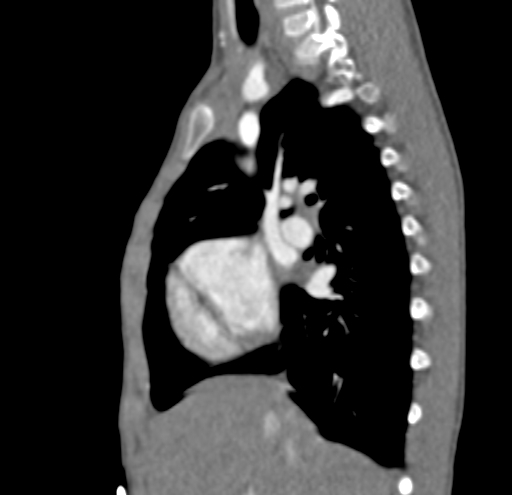 File:Aortopulmonary window, interrupted aortic arch and large PDA giving the descending aorta (Radiopaedia 35573-37074 C 1).jpg