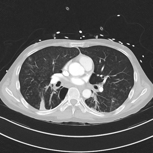 Apical bullous disease in a heavy smoker (Radiopaedia 33067-34092 Axial lung window 34).png