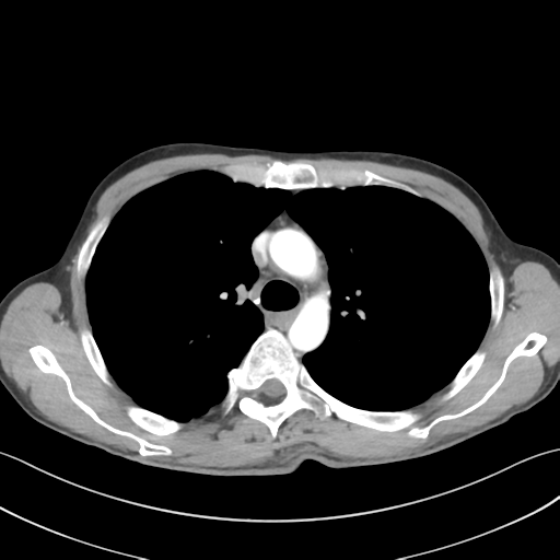 Apical pleural calcification (Radiopaedia 46141-50499 Axial C+ delayed 23).png