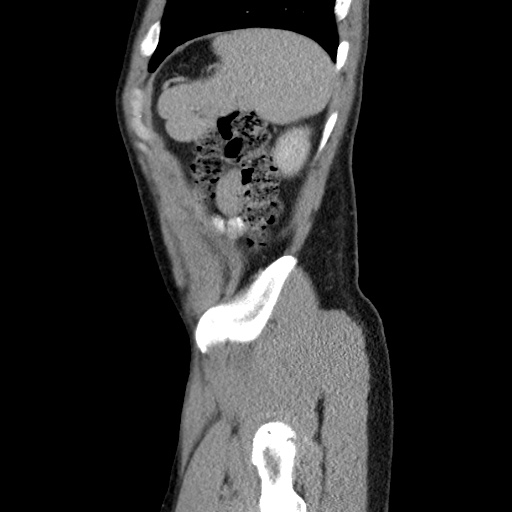 Appendicitis complicated by post-operative collection (Radiopaedia 35595-37114 C 60).jpg