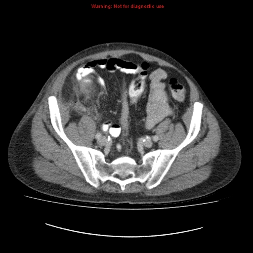 File:Appendicitis mass in inguinal hernia (Radiopaedia 26858-27029 A 11).jpg