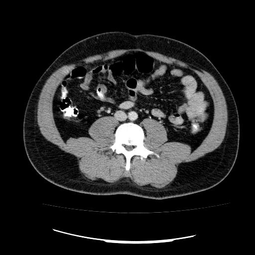 File:Appendicitis with diverticulosis (Radiopaedia 47693-52383 Axial C+ 82).jpg