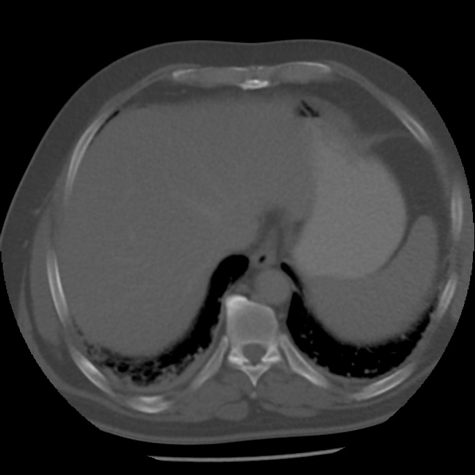 Appendicitis with perforation (Radiopaedia 35790-37342 Axial bone window 6).jpg